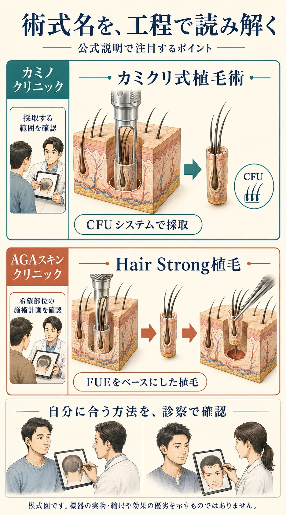 カミノクリニックのカミクリ式植毛術と、AGAスキンクリニックのHair Strong植毛について、公式説明で注目する工程と診察時の確認点を比較した模式図。