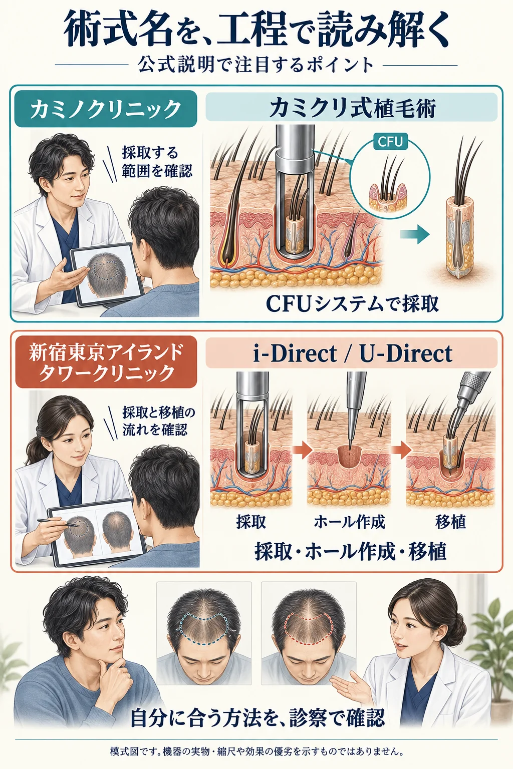 カミノクリニックのカミクリ式植毛術と、新宿東京アイランドタワークリニックのi-Direct / U-Directについて、公式説明で注目する工程と診察時の確認点を比較した模式図。