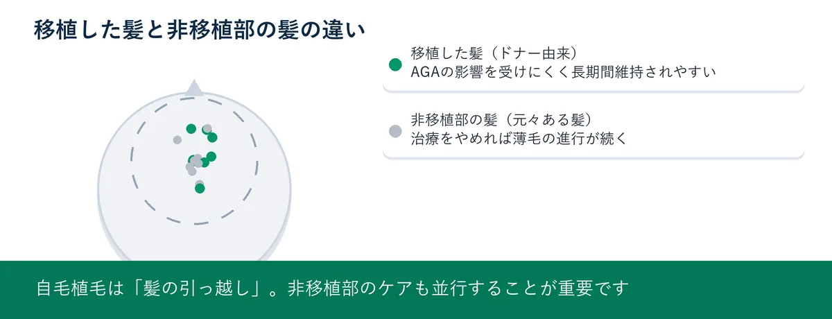 移植した髪はAGAの影響を受けにくいが非移植部は治療をしなければ薄毛が進行し続けるという図解