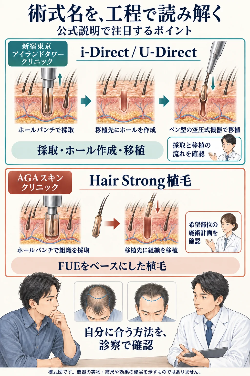 新宿東京アイランドタワークリニックのi-Direct / U-Directと、AGAスキンクリニックのHair Strong植毛について、公式説明で注目する工程と診察時の確認点を比較した模式図。