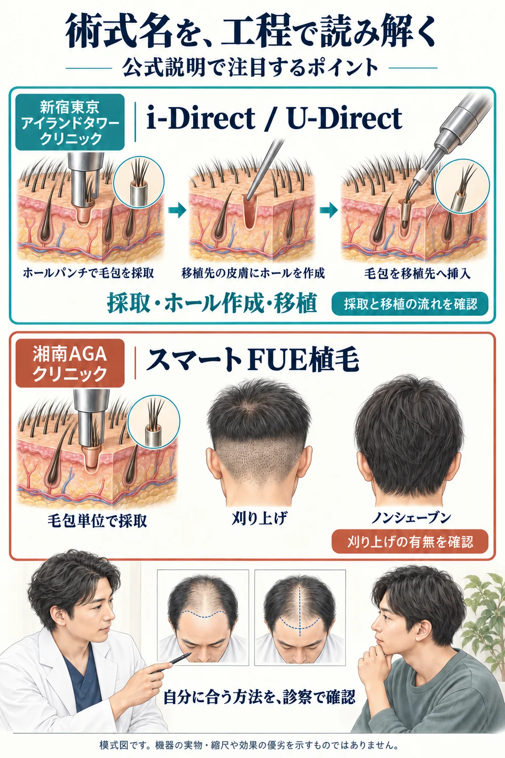 新宿東京アイランドタワークリニックのi-Direct / U-Directと、湘南AGAクリニックのスマートFUE植毛について、公式説明で注目する工程と診察時の確認点を比較した模式図。