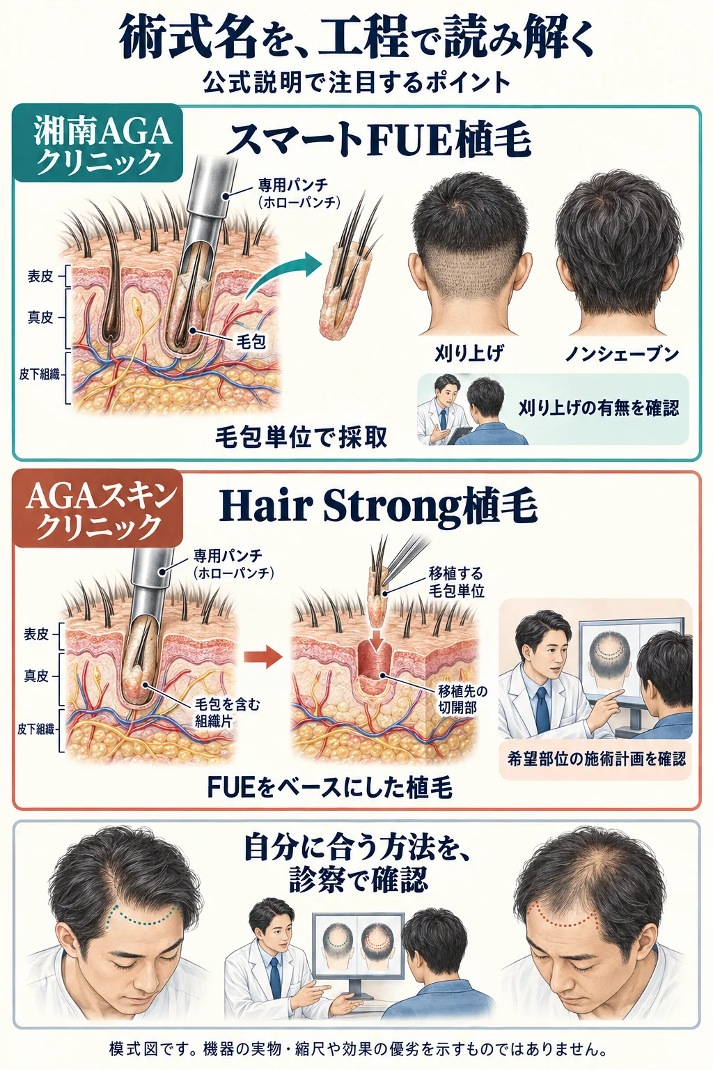 湘南AGAクリニックのスマートFUE植毛と、AGAスキンクリニックのHair Strong植毛について、公式説明で注目する工程と診察時の確認点を比較した模式図。